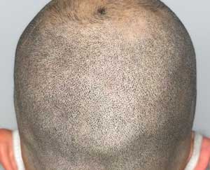 scalp micropigmentation after